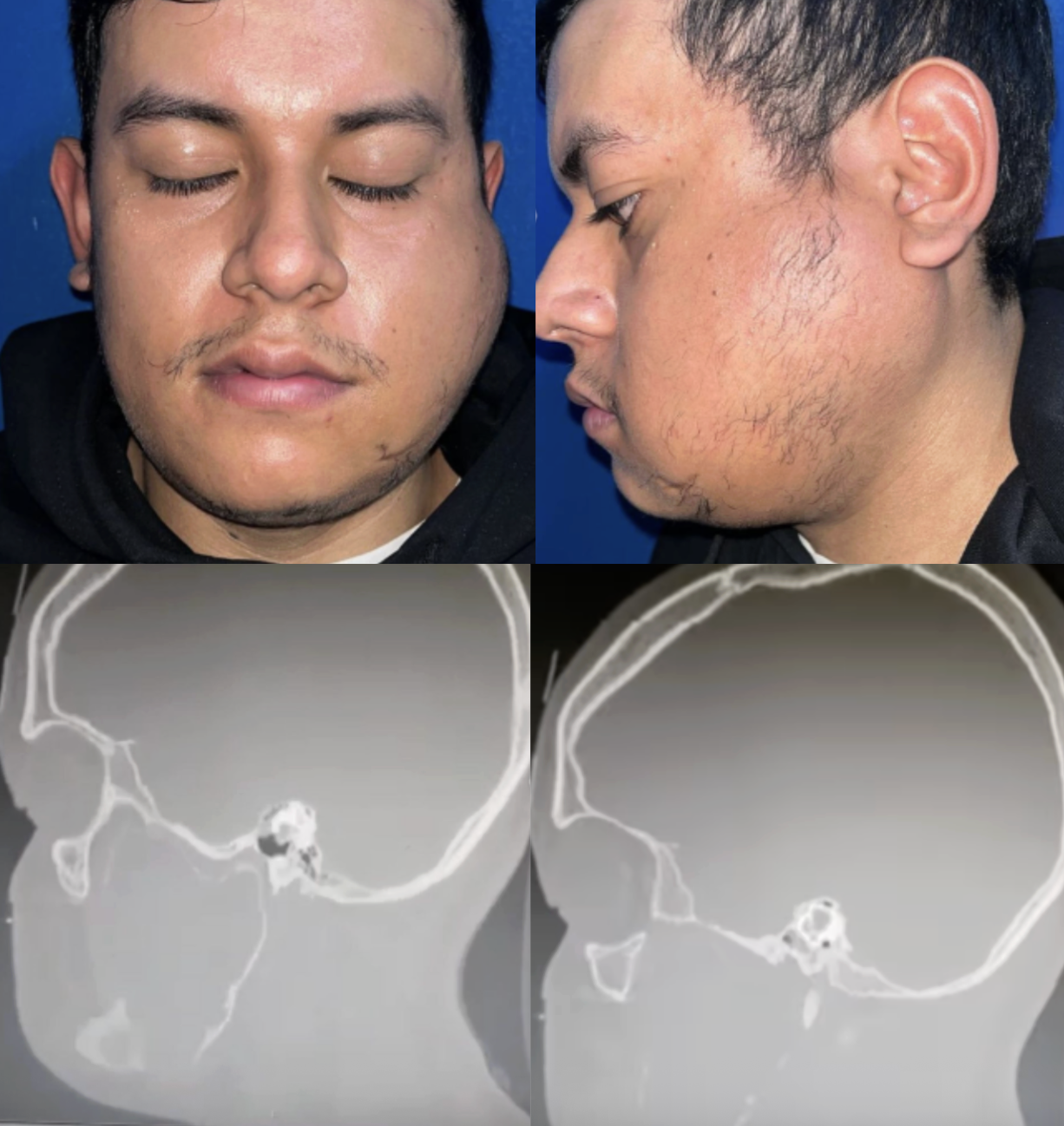 22 Year Old With Ameloblastoma of the Mandible