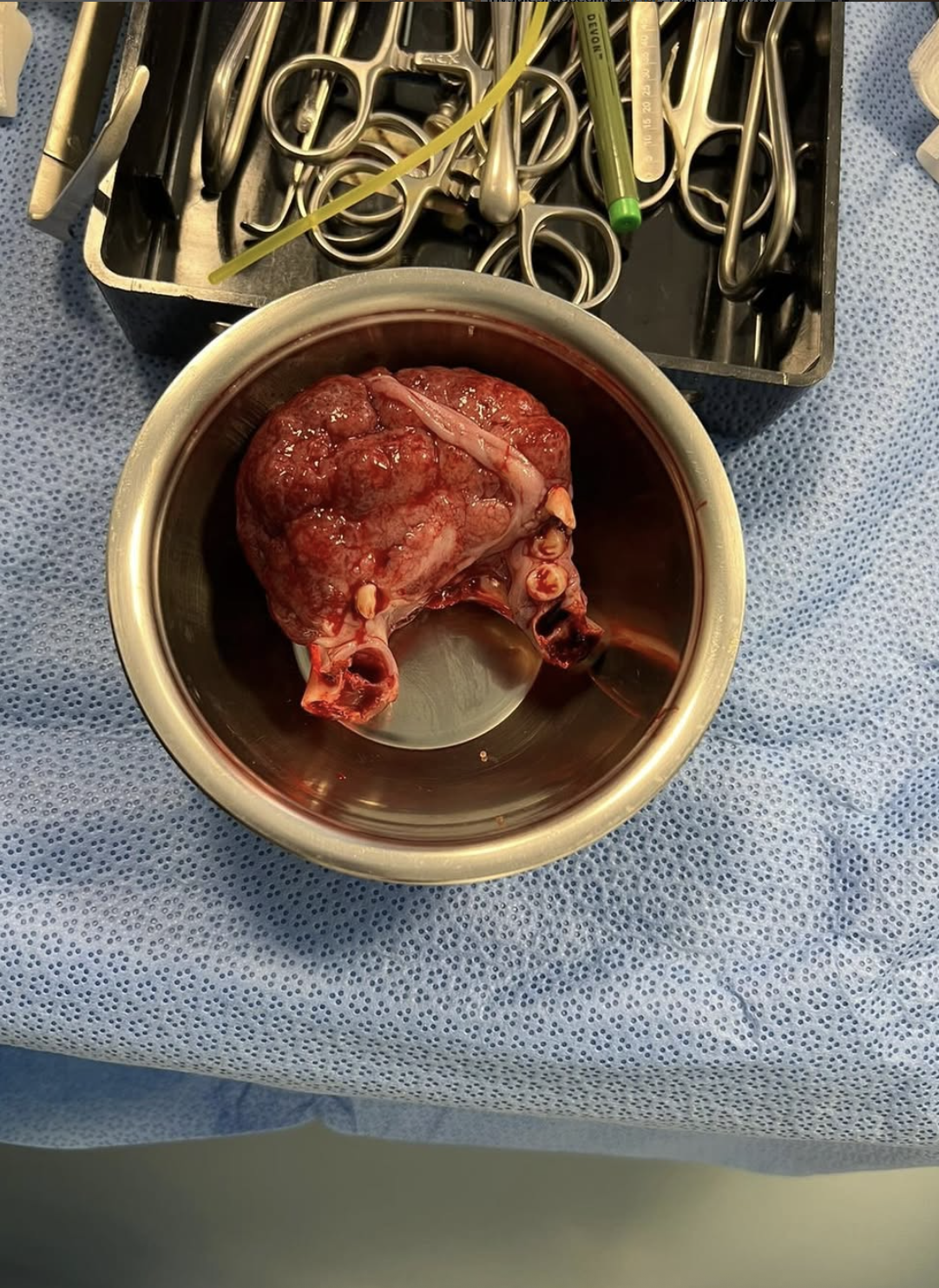 Post-op reconstruction