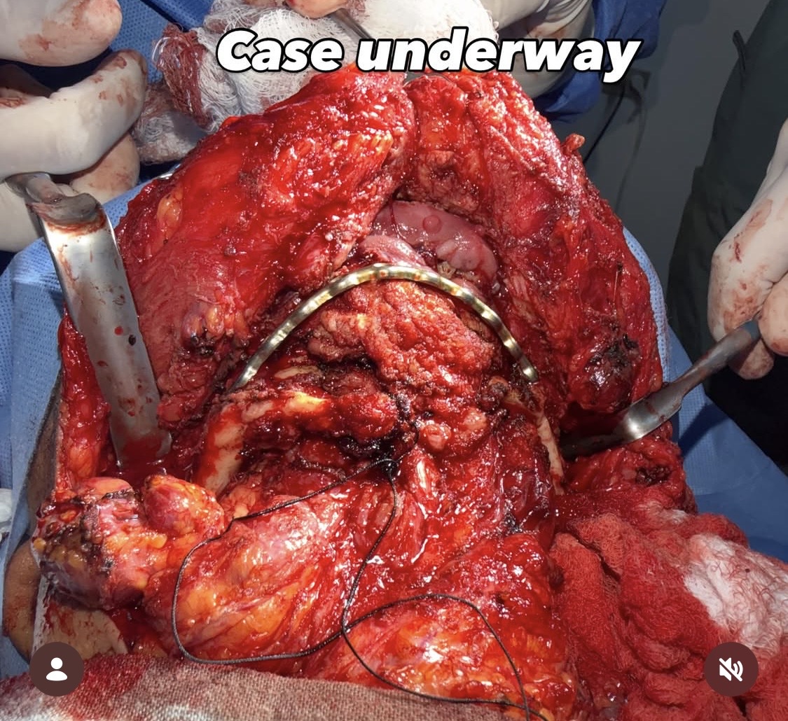 Case Underway: Mandible Reconstruction After Gunshot Injury — Guatemala