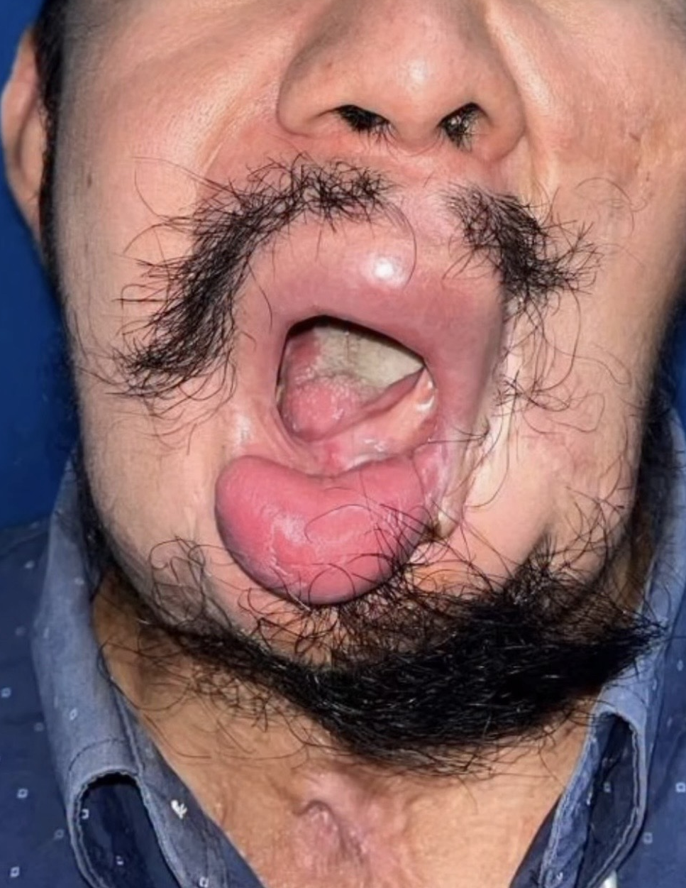 Upcoming: Mandible Reconstruction After Gunshot Injury — Guatemala, September 2026