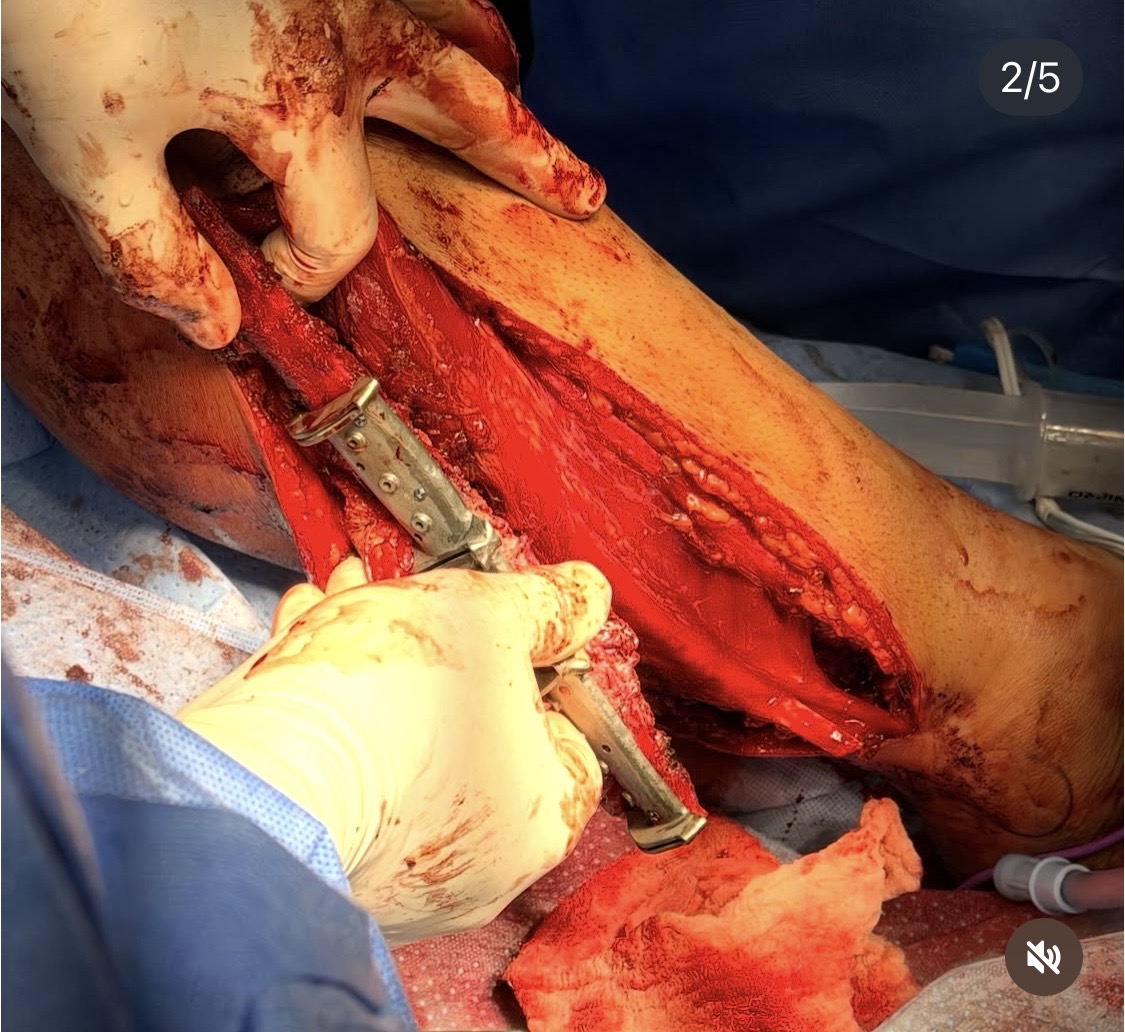 Intra-operative right fibula harvest with a cutting guide on the donor bone