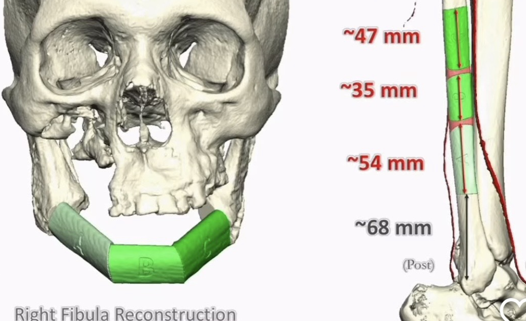 Virtual surgical plan — right fibula reconstruction