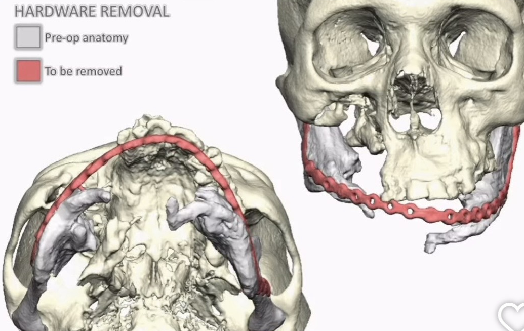 Virtual surgical plan — hardware removal