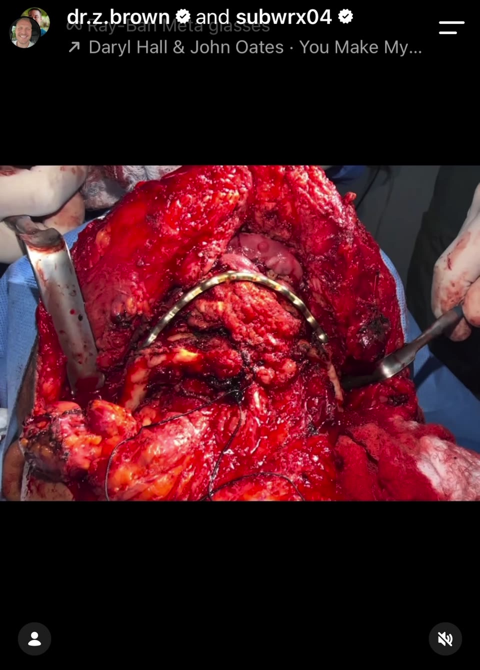 Intra-operative view of the reconstruction plate in the field