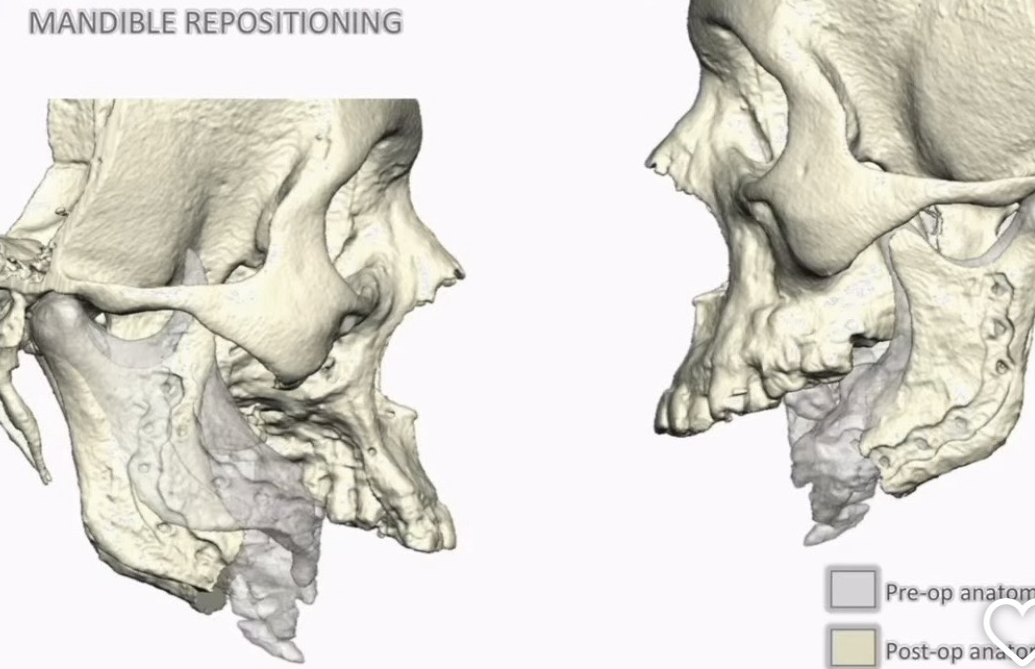 Virtual surgical plan — mandible repositioning