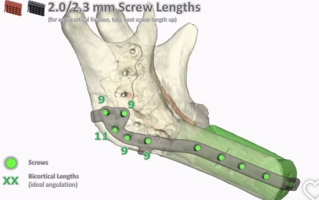 Virtual surgical plan — reconstruction plate and screw lengths