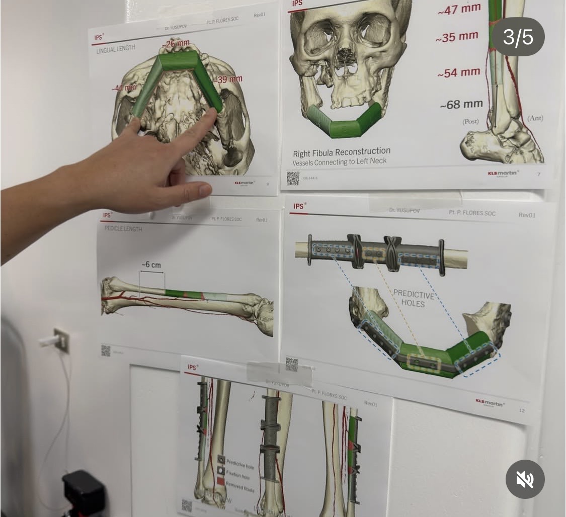 Virtual surgical planning posters on the operating room wall for mandible and fibula reconstruction