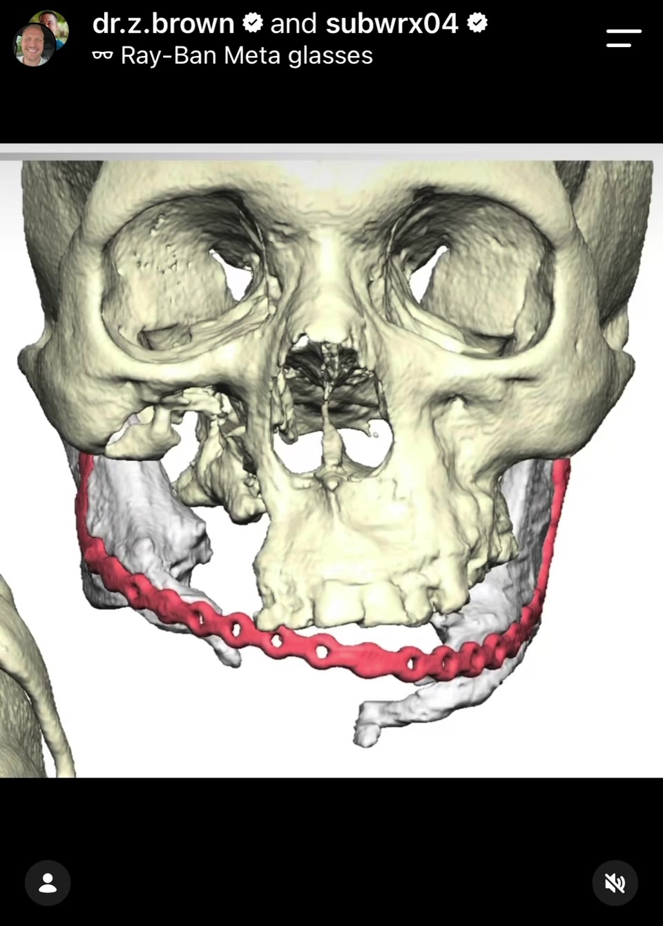 3D surgical plan of the mandible with a reconstruction plate spanning the defect