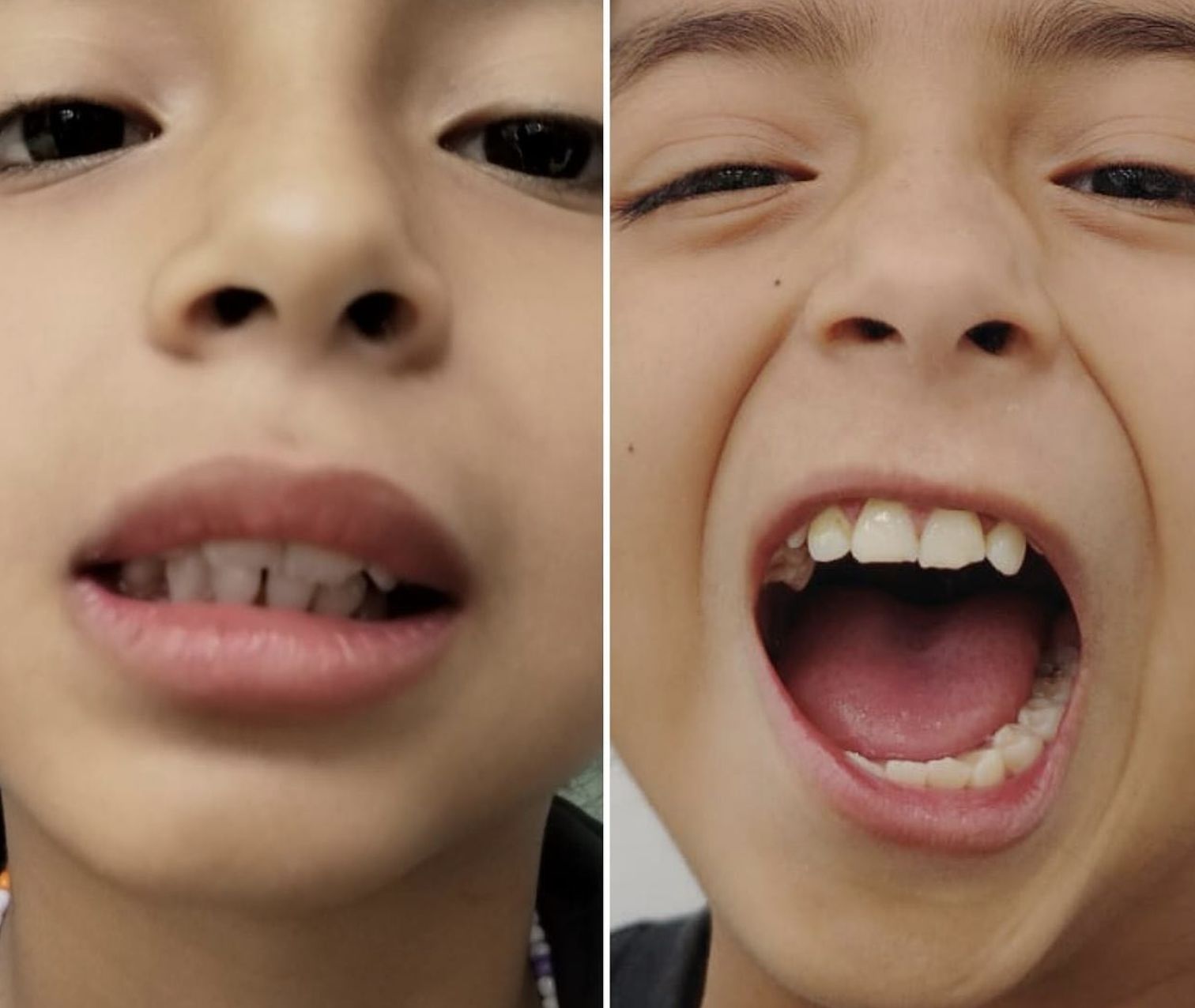 9 Year Old with TMJ Ankylosis